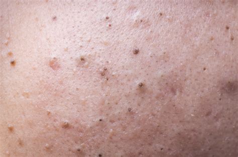 What Causes Blackheads On The Nose And How To Get Rid Of Them
