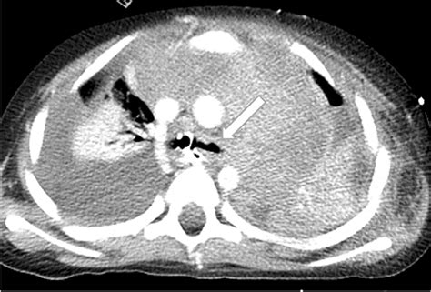 T Cell Lymphoblastic Mediastinal Lymphoma Axial Ct In A 10 Year Old