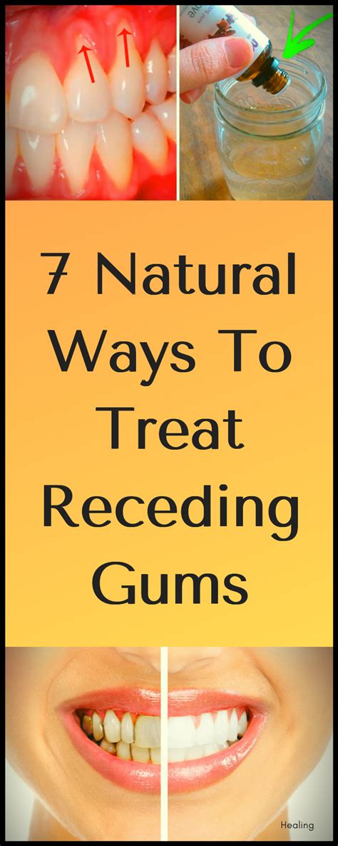 7 Natural Ways To Treat Receding Gums Receding Gums Oral Health