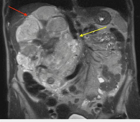 Mri Adrenals With And Without Contrast Coronal View Revealing A Large