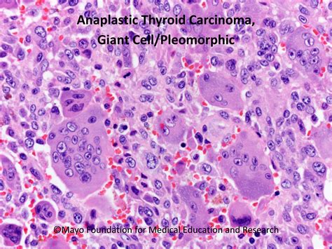 Anaplastic Thyroid Carcinoma Mayo Clinic Proceedings