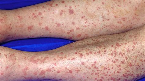 Hordozható Biztonság Mennyiségben Skin Rash On Legs Évszak Tekintettel