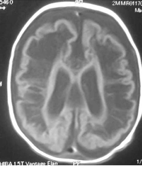A Mri Brain Of Patient 1 Showing Cystic Encephalomalacia Download