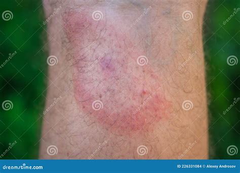 Migrating Erythema After A Tick Bite On A Man`s Leg Stock Photography