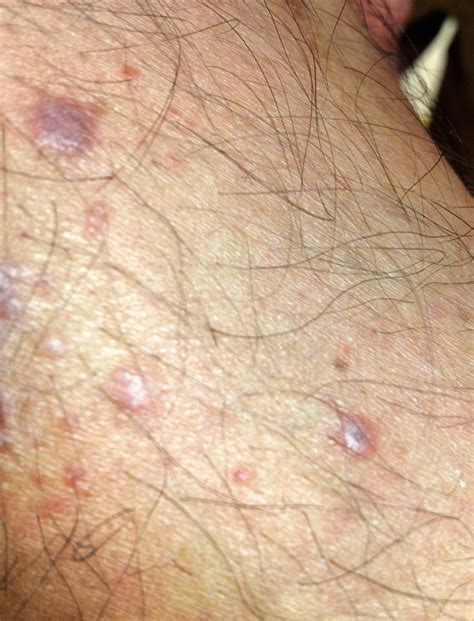 Dark Itchy Leg Lesions In A Middle Aged Man