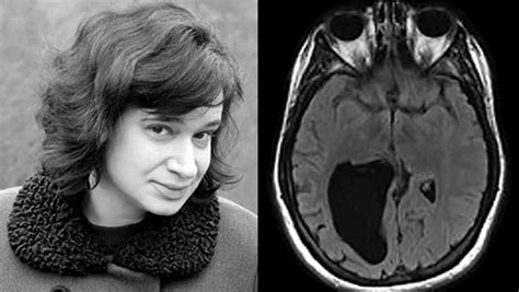 Cole Cohen The Woman With A Lemon Sized Hole In Her Brain Cbs News