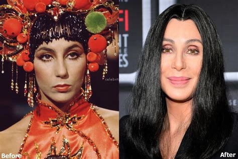 Cher plastic surgery rumours include having brow lift, face lifts, botox and fillers. Cher Plastic Surgery Before and After - Celebrity Dr.