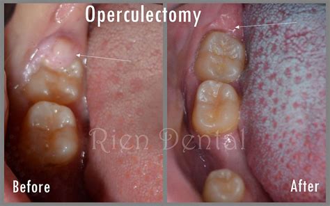 Operculectomy A Minor Surgery For Wisdom Teeth