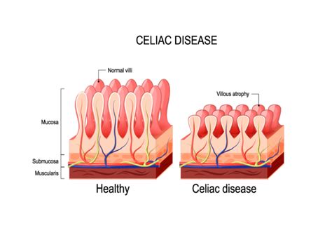 Celiac Disease Dr Ong Paediatrician And Gastroenterologist