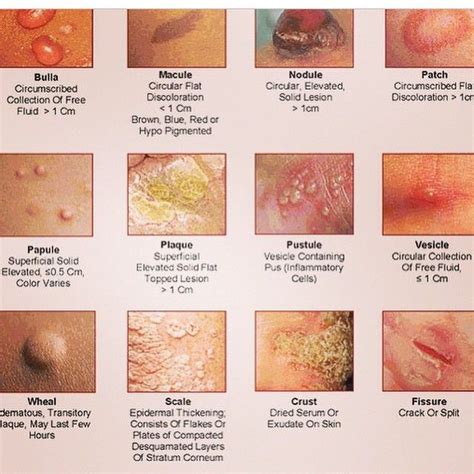 Medical Doctor On Instagram “different Skin Rashes Rash Skin Scale Pustule Bulla