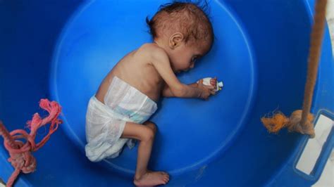 Unicef Alerta Para Número Recorde De Desnutrição Infantil No Iêmen