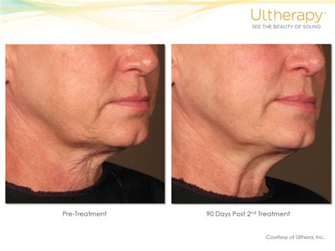 Ultherapy Results Under The Chin Ultherapy BeforeandAfter Ultherapy Cosmetic Solution