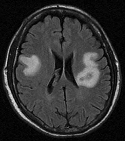Brain Abscess Causes Signs Symptoms Diagnosis Treatment And Complications