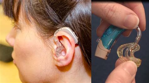 Everything You Need To Know About Hearing Aid Earmolds Vs Open Fit Domes