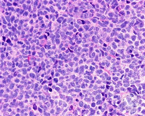Mantle Cell Lymphoma 2
