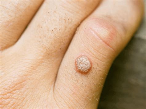 Everything To Know About The Wart Removal Fosep