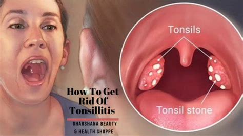 Sign Of Tonsillitis Causes Symptoms And Treatment How To Get Rid Of Tonsillitis Youtube