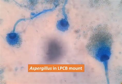 Aspergillus In Lpcb Mount Introduction Principle Preparation Result