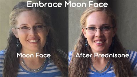 Embrace And Reduce Moon Face Dr Megan Side Effects Solutions