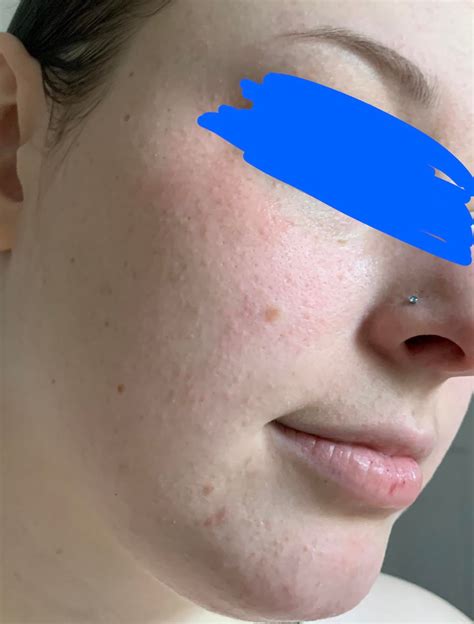 Weird Bumps Are Appearing On My Face They Dont Fade Away With Time
