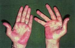 Palmar erythema, often called liver palms, is reddening in both of the palms. Palmar erythema | definition of palmar erythema by Medical ...