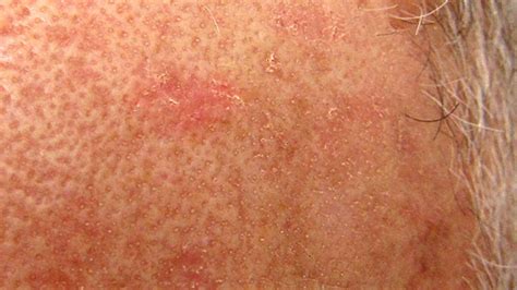 Actinic Keratosis Causes Symptoms And Treatment