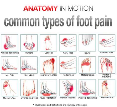 Foot Pain Instep Symptoms Ball Of Foot Pain