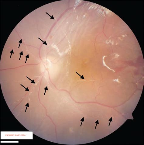 Pars Plana Vitrectomy Surgery For Kyrieleis Plaques With Ret
