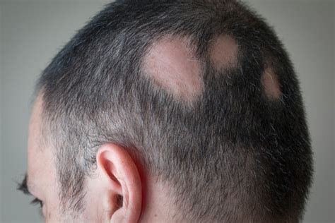 Alopecia Areata Causas Sintomas Tratamento PrePara ENEM