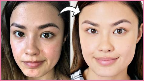 Then, after 3 days of using my hn crystal face, i made a small amount of it like a dry one or a lot of. How I Manage My Breakouts (Skin Reactions) | My Experience ...