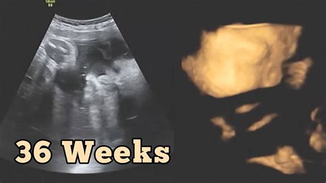 Ultrasound At 36 Weeks Pregnant 9th Month Pregnancy Growth Scan Youtube