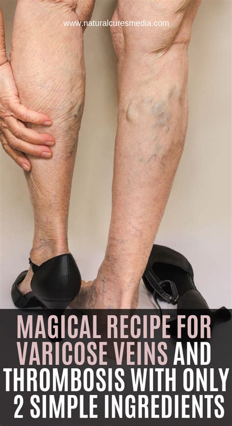 Magical Recipe For Varicose Veins And Thrombosis With Only 2 Simple