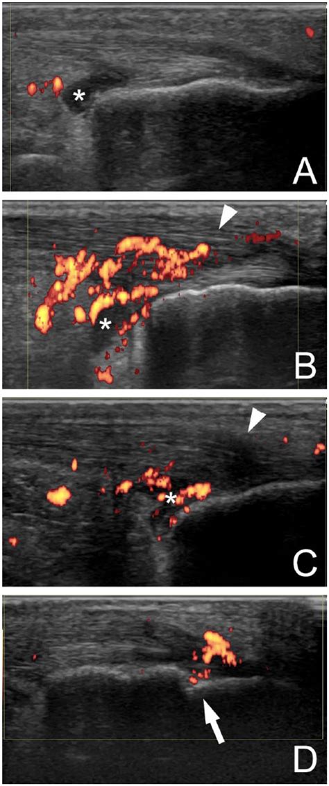 Representative Ultrasound Us Images Of The Achilles Tendon At