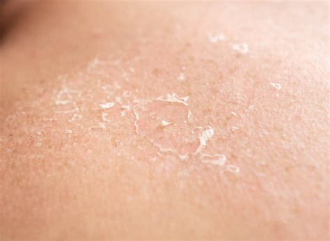 Dry Skin Stock Photos Pictures And Royalty Free Images Istock