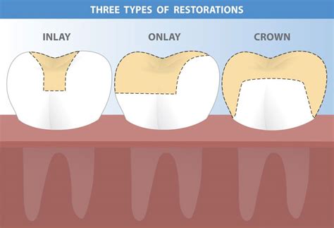 Inlays And Onlays Carntyne Dental Care