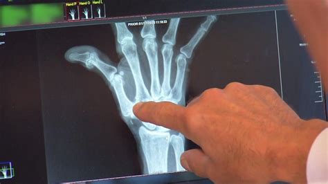 Health Beat Cmc Surgery For Thumb Arthritis Health Beat