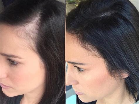 Details More Than 124 Hair Thinning At Front Female Super Hot Ceg Edu Vn