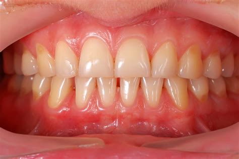 Gum Disease Therapy In Jacksonville Can Solve Your Painful Gums