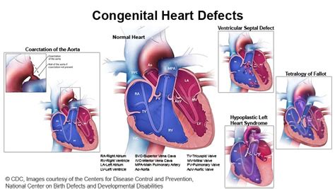 Congenital Heart Defects Causes Symptoms And Treatments