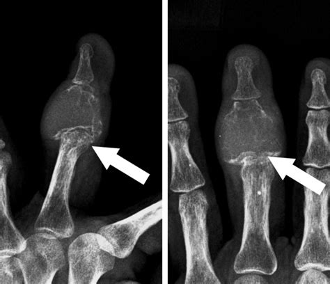 Giant Cell Tumour Of The Middle Phalanx Of The Middle Finger Bmj Case