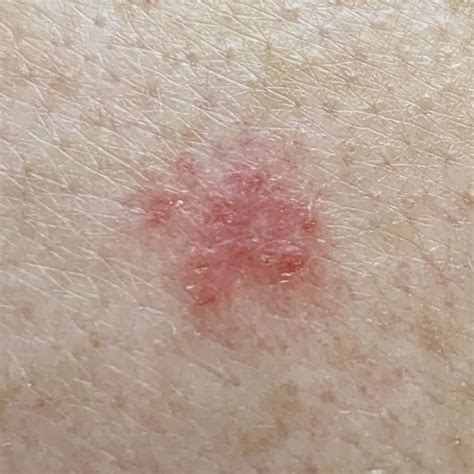 Superficial Basal Cell Carcinoma Spot Check Skin Cancer Aesthetics