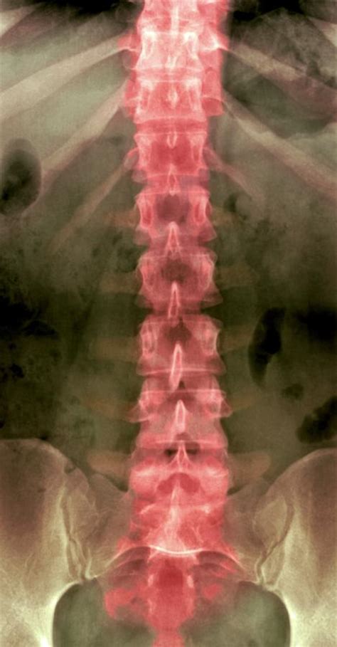 Levoscoliosis of the lumbar spine consider predisposition to lumbosacral instability. Normal Lumbar Spine, X-ray Photograph by Du Cane Medical ...