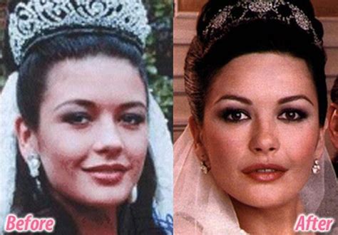 Stars before and after plastic surgery (47 pics ...