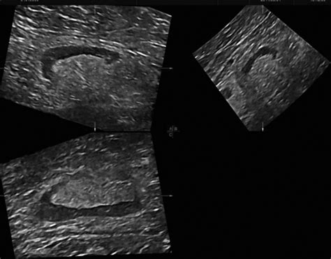 Three‐dimensional Sonography Of Axillary Lymph Nodes In Patients With