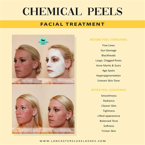Chemical Peels — Lancasters Luxe Lashes