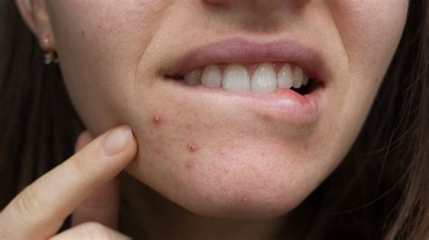 What Causes Pimples Around Your Lips