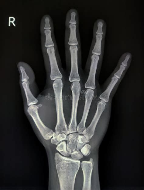 X Ray Of Hand