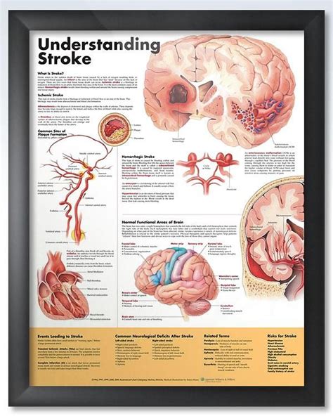 Understanding Stroke 20x26 Anatomy Poster Medical Technology Medical