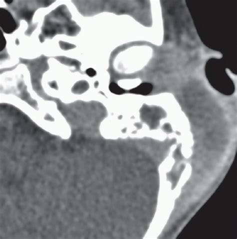Mastoiditis Radiology Key