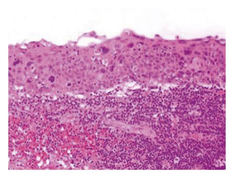 Histopathologic Examination Of The Excised Cervical Lymph Node Revealed